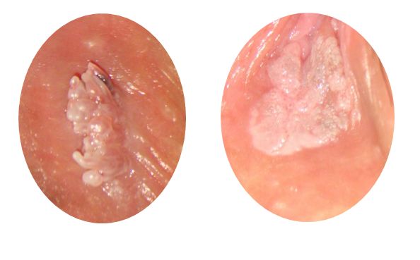 尖锐湿疣,近期高发，局部突起性病。