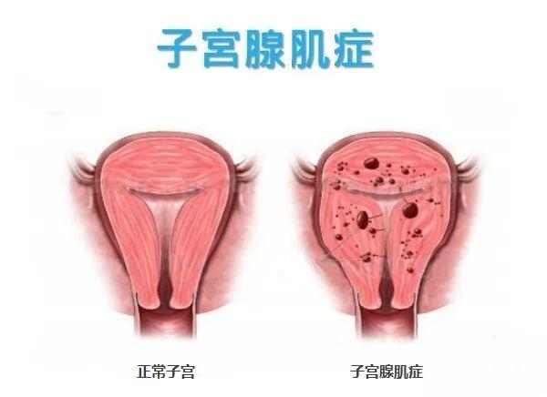 子宫腺肌症最新治疗,子宫腺肌症治疗迎来新突破