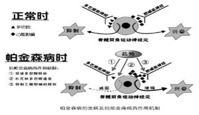 最新治疗帕金森特效药,突破性进展！首个帕金森病治疗神药问世。