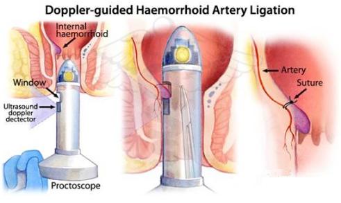痔疮最新疗法,“痔疮治疗新突破，前沿疗法受瞩目”