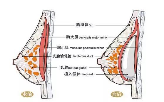 最新丰胸技术,前沿美胸术革新成果显著。