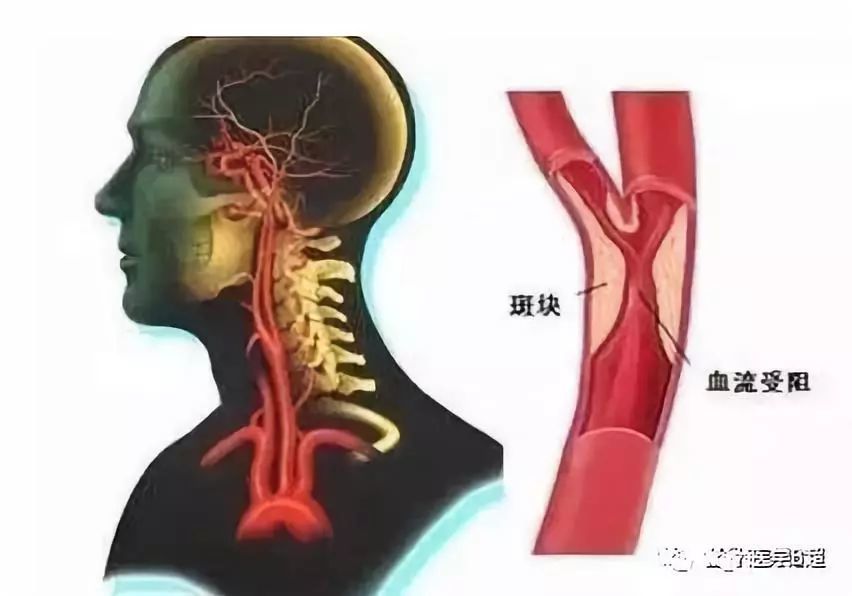 颈动脉斑块最新治疗方案,颈动脉斑块治疗新进展解析