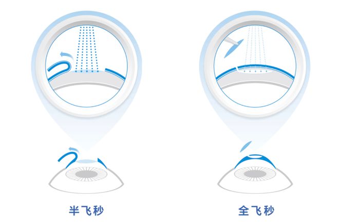 治疗近视眼的最新技术,创新近视眼矫正技术盘点